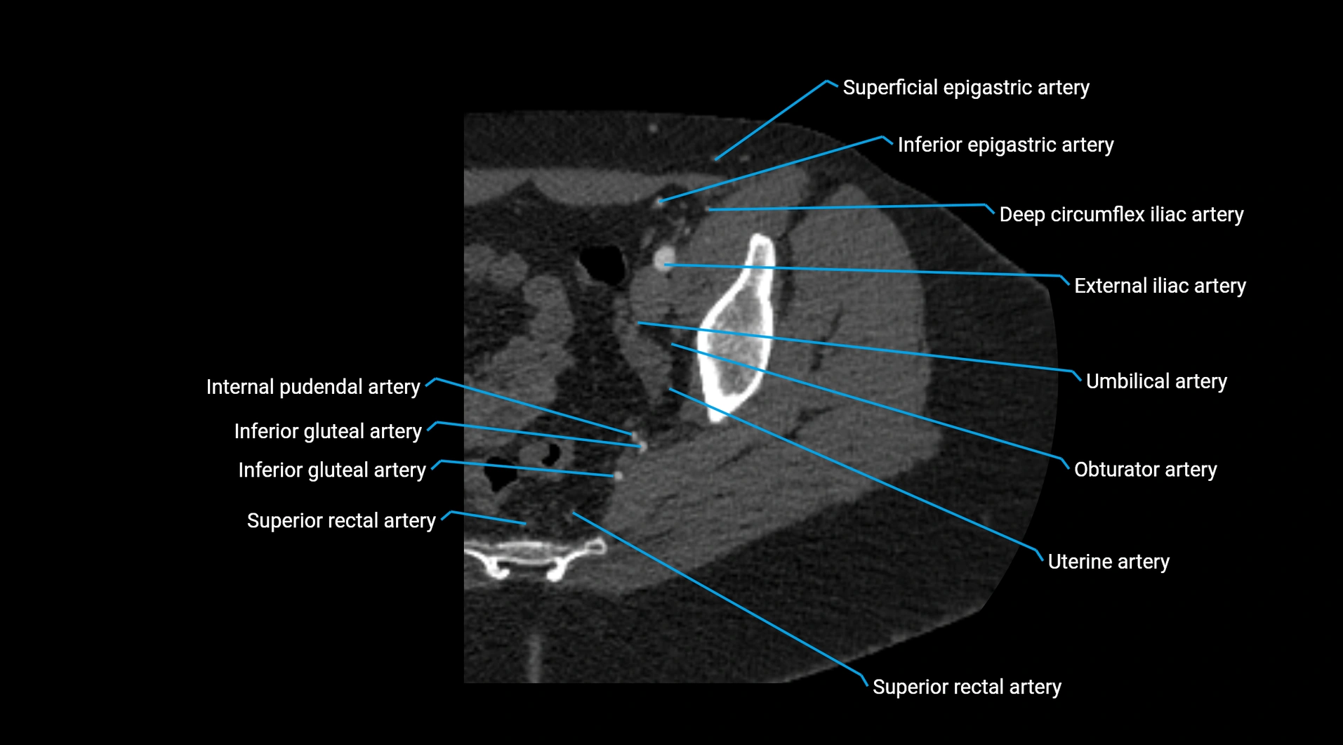 CTA lower limb cross sectional anatomy labelled image _43.webp